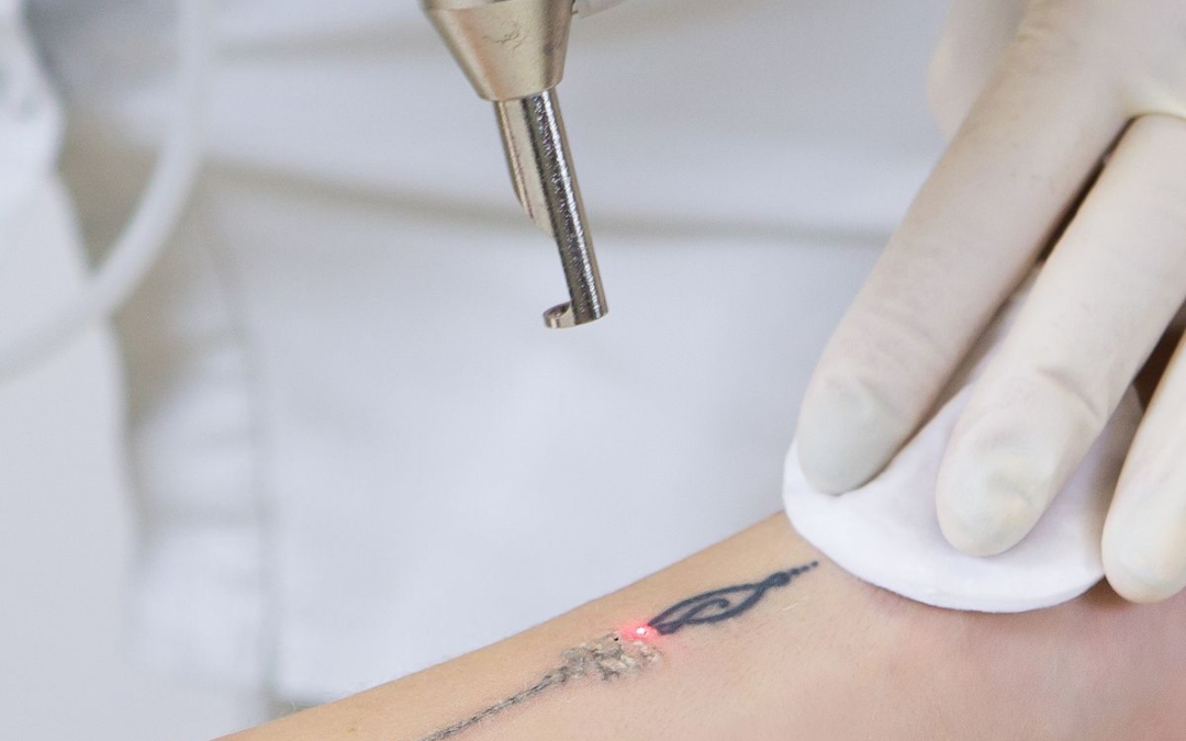How To Remove a Tattoo: Types, Stages, Contraindications